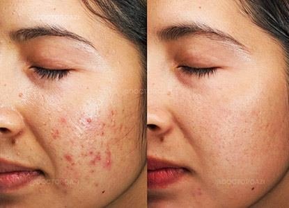 Acne Treatment at Dr Sree Healthcare