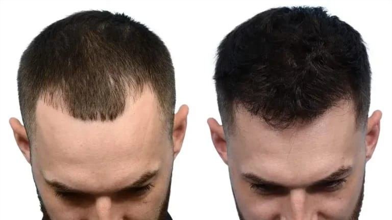 PRP Hair Treatment at Dr Sree Healthcare