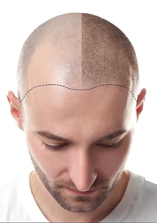 Scalp Micropigmentation at Dr Sree Healthcare