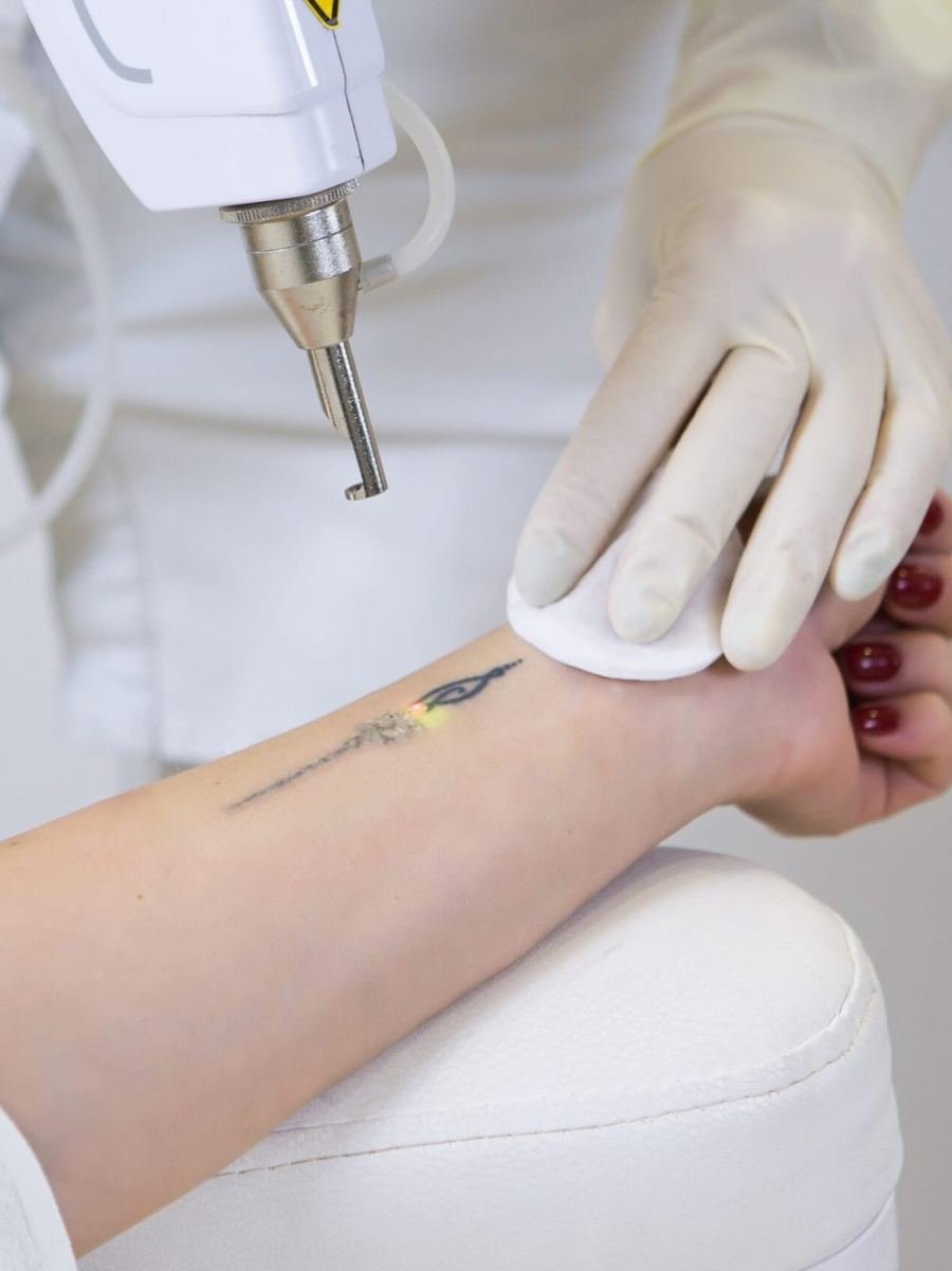 Tattoo Removal at Dr Sree Healthcare